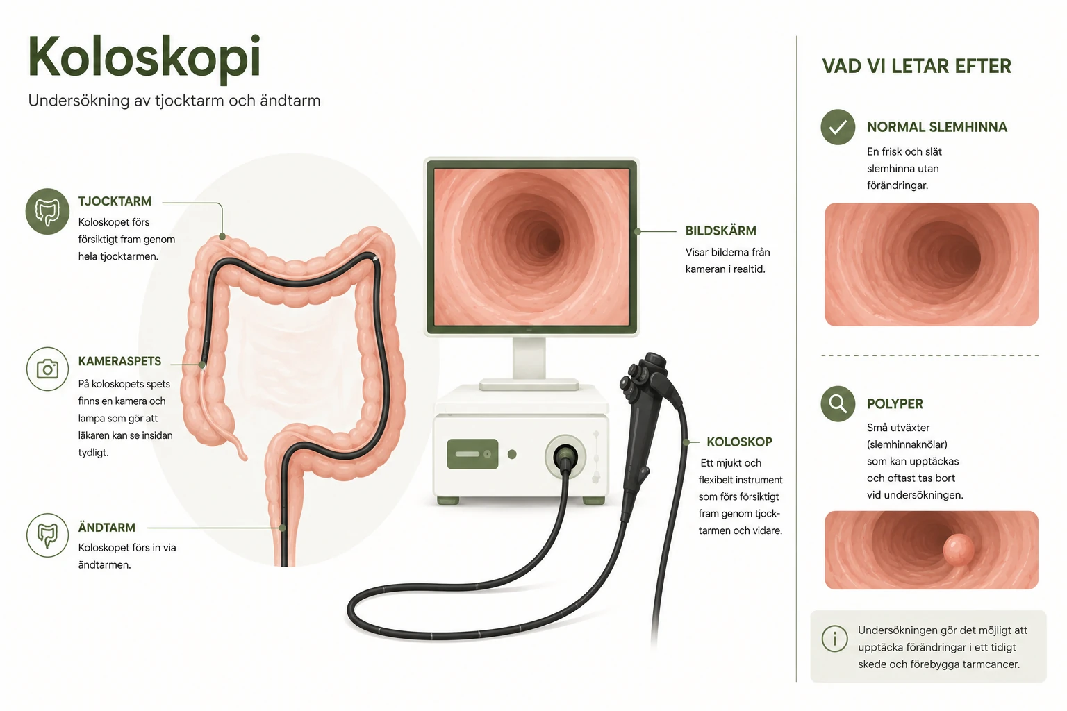 Infografik som visar koloskopets väg genom ändtarmen och tjocktarmen samt hur normal slemhinna och polyper kan se ut