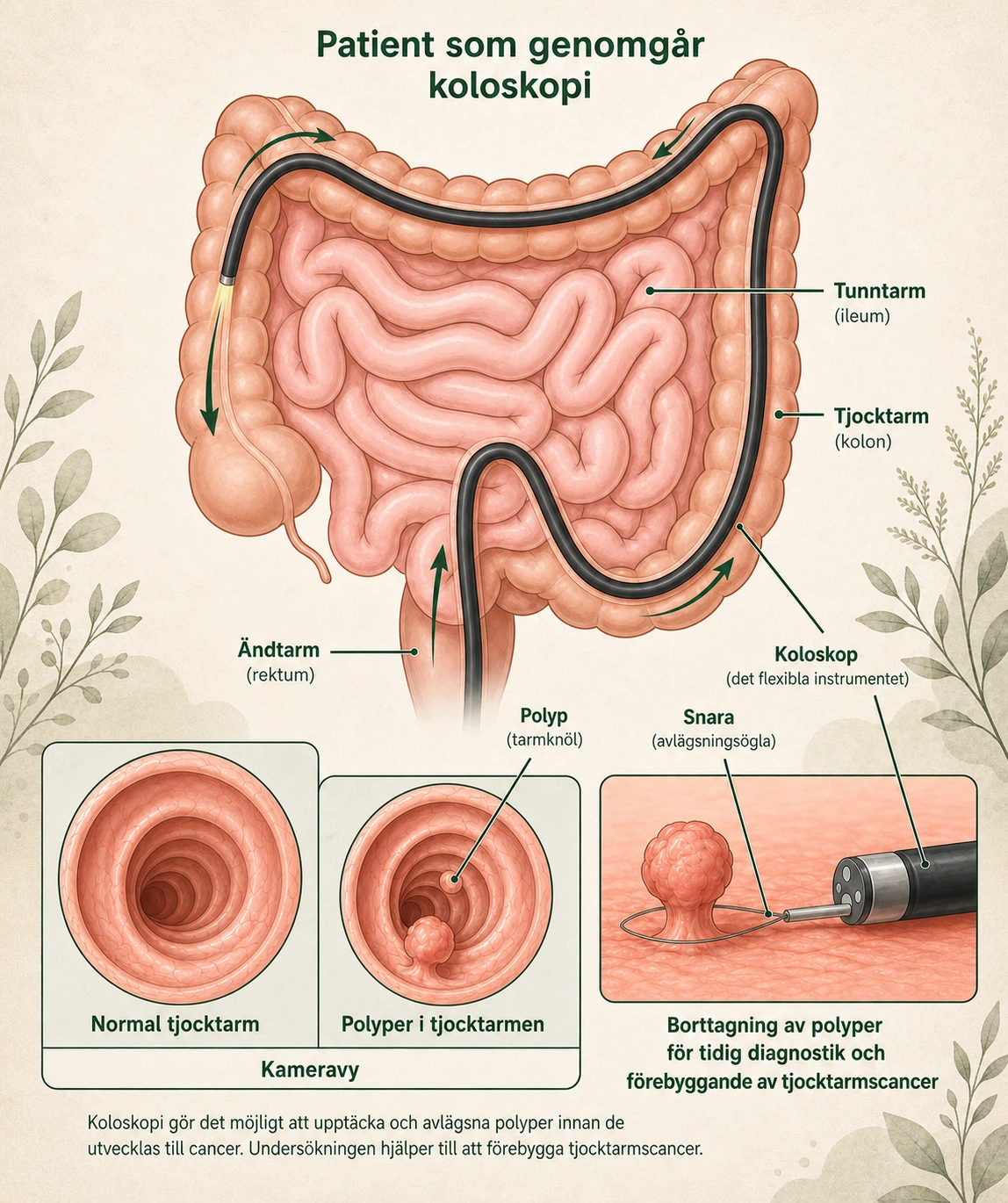 Svensk infografik som visar koloskopets väg genom tjocktarmen, normal slemhinna, polyper och hur en polyp kan tas bort